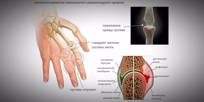 Артралгия суставов кисти без изменений на снимках боли суставах рук