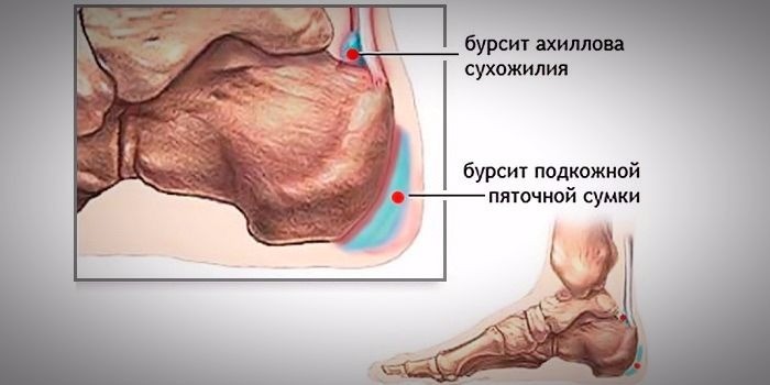 Моча при воспалении суставной сумки лошадиный бальзам для суставов цена в аптеке
