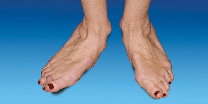 Деформирующий артрит нижних конечностей