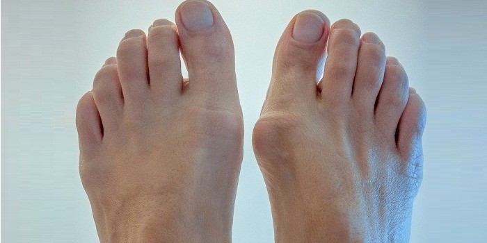 Воспаление суставной сумки большого пальца стопы