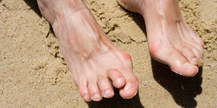 Воспаление суставов пальцев ног