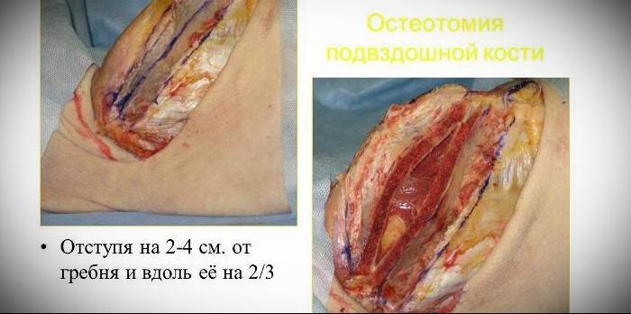 Остеотомия подвздошной кости