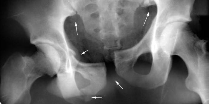 Перелом подвздошной кости на рентгеновском снимке