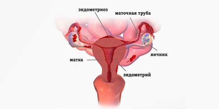 Эндометриоз матки