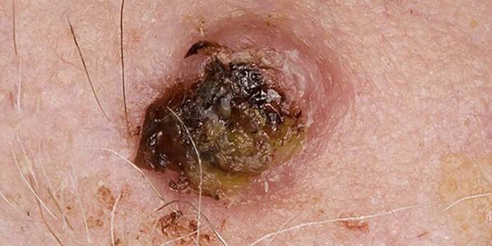 Базально-клеточный рак кожи