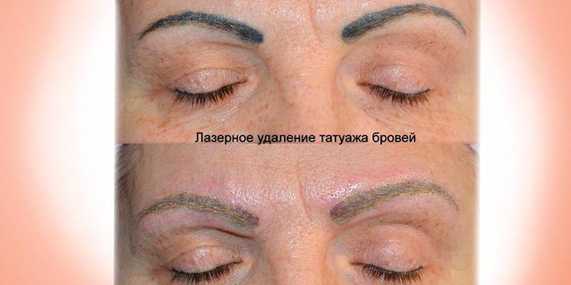 До и после проведения процедуры