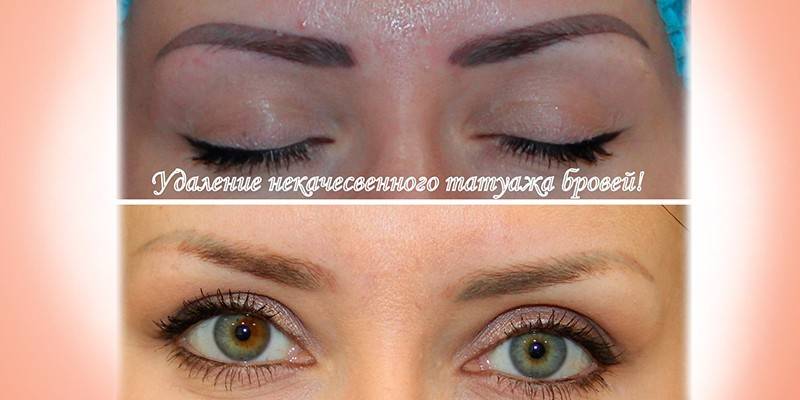 Девушка после удаления некачественного татуажа