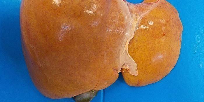 Пораженная жировым гепатозом печень