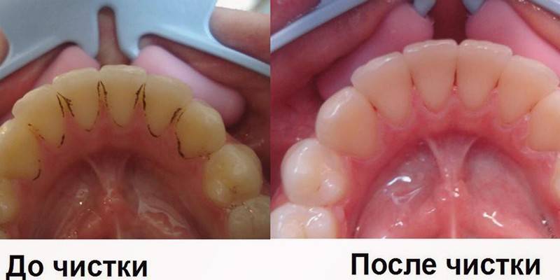 Снятие зубного камня