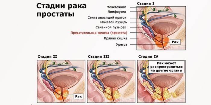 Стадии рака предстательной железы