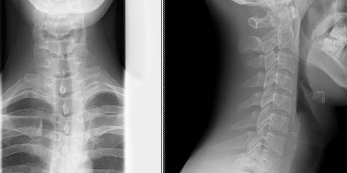 Рентгеновский снимок шейного отдела позвоночника