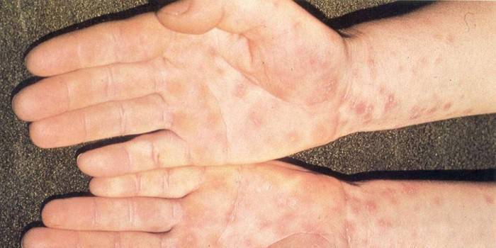 Сыпь при сифилисе на коже рук