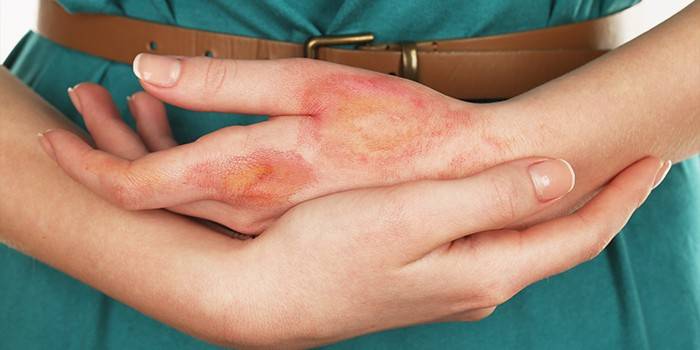 Наличие повреждений кожи на руках