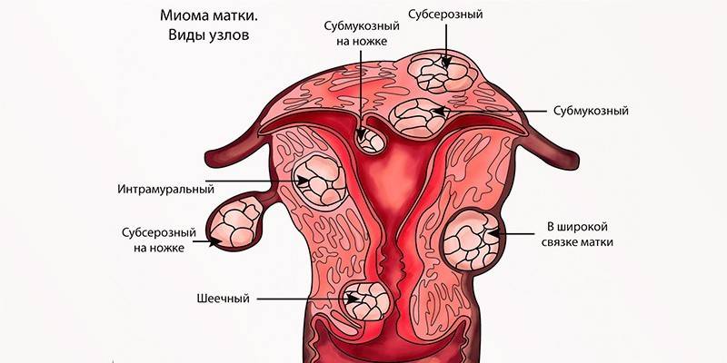 Виды миом