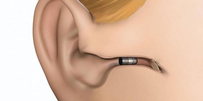 Схема расположения внутриканального слухового аппарата