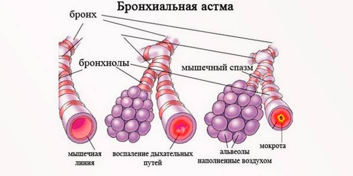 Бронхи при астме