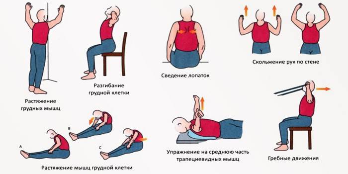 Физические упражнения при шейном остеохондрозе