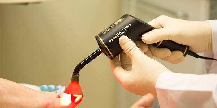 Проведение лазерной терапии ногтя стопы