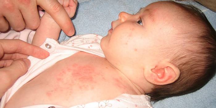 Высыпания при розеоловирусе на теле у малыша
