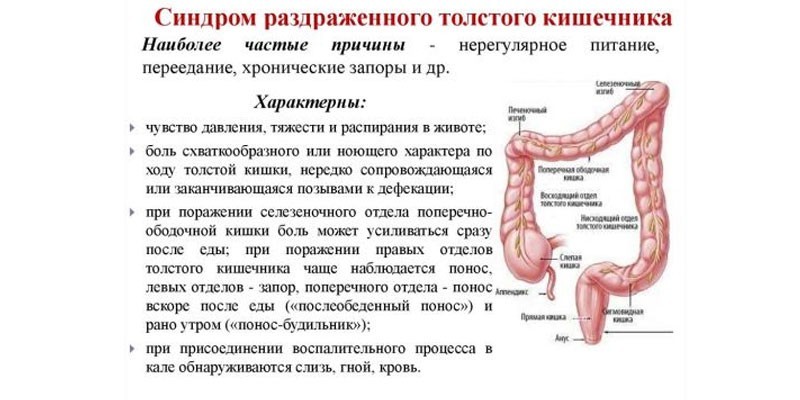Симптомы синдрома раздраженного кишечника
