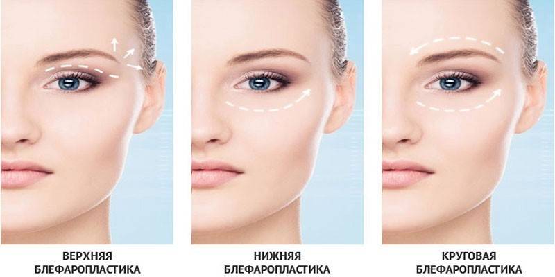 Виды блефаропластики