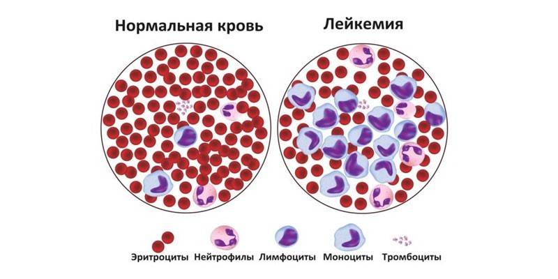 Нормальная кровь и при лейкемии 