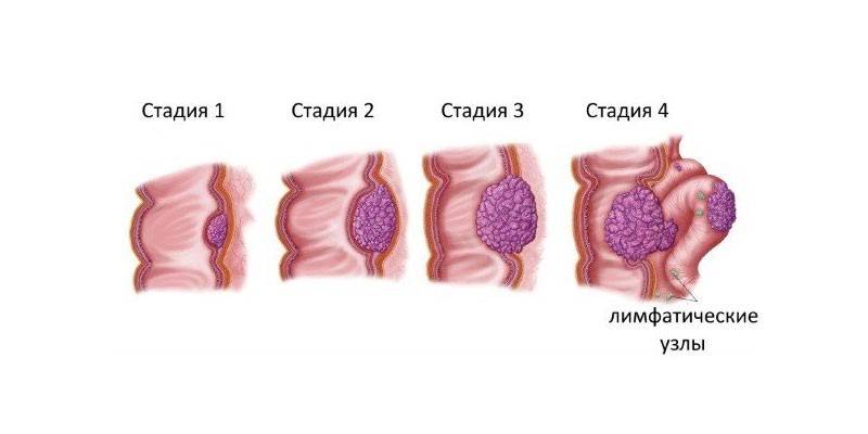 Стадии рака толстой кишки