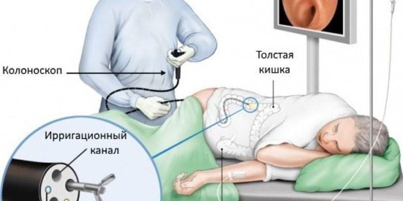 Процедура колоноскопии
