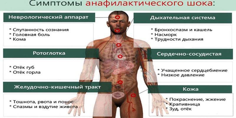 Симптомы анафилактического шока