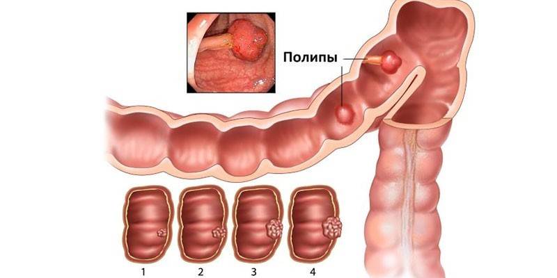 Полипы в кишечнике
