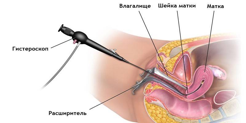 Способ удаления новообразований