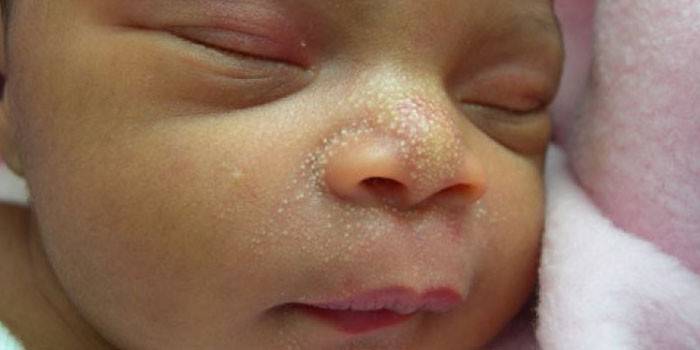Белые точки на лице у новорожденного