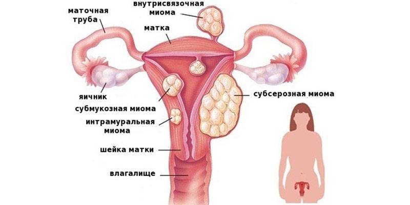 Виды миом