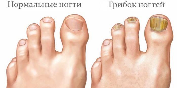 Поражение ногтей грибковой инфекцией