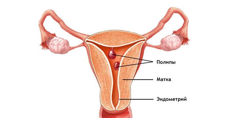 Схема локализации полипов