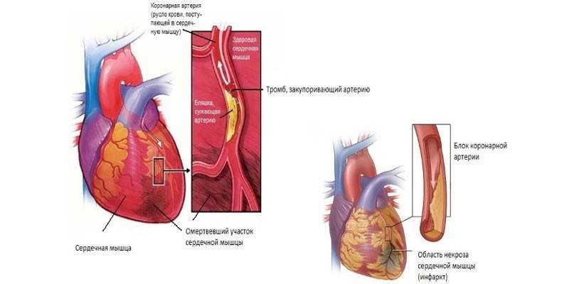 Схема тромба в сердце