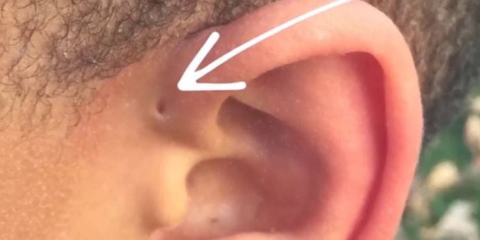 Врожденный свищ возле уха