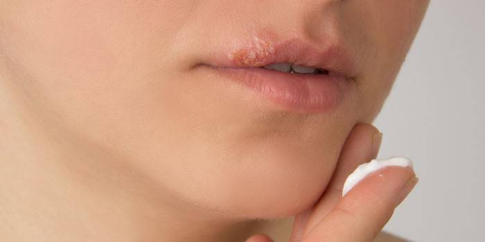 Лечение герпеса на губах