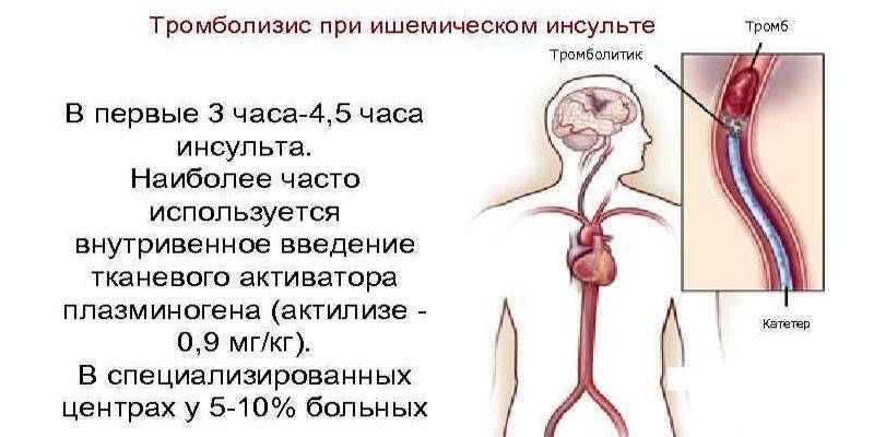 Тромболизис при инсульте