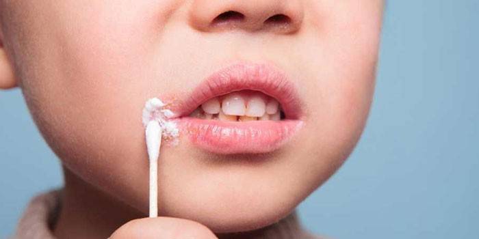 Простуда на губах у ребенка