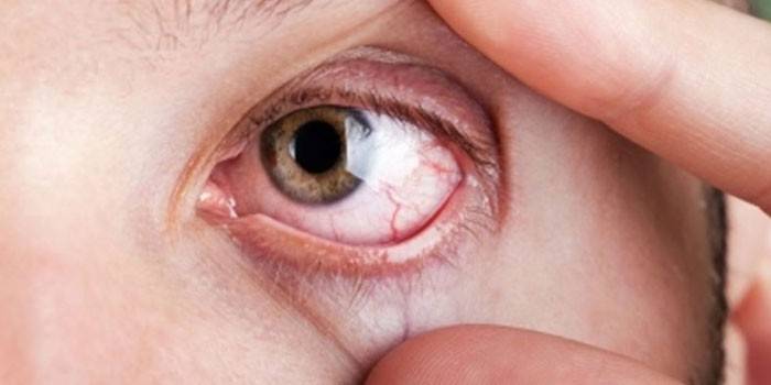 Грибковая инфекция глаза