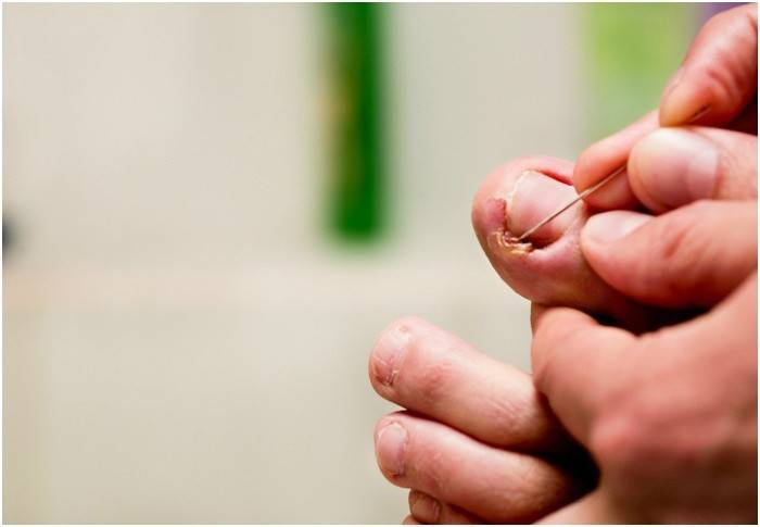 Лечение вросшего ногтя на ноге: как вылечить в домашних условиях?